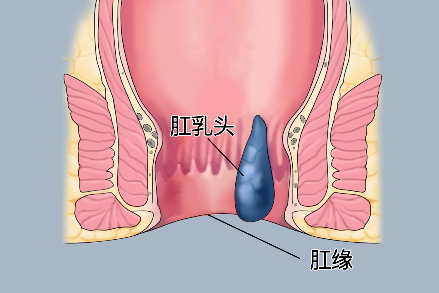 肛门乳头状纤维组织瘤图 肛门乳头状纤维组织瘤图