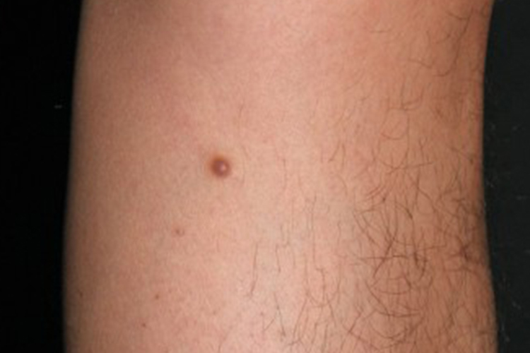 皮肤纤维瘤图 皮肤纤维瘤图