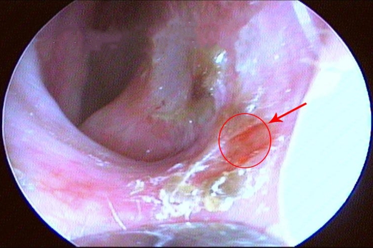 鼻黏膜糜烂图 鼻黏膜糜烂图