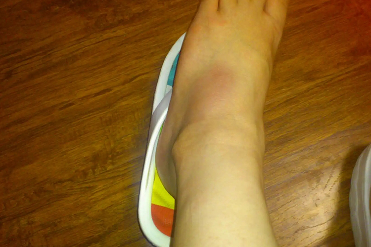 脚踝扭伤肿胀图