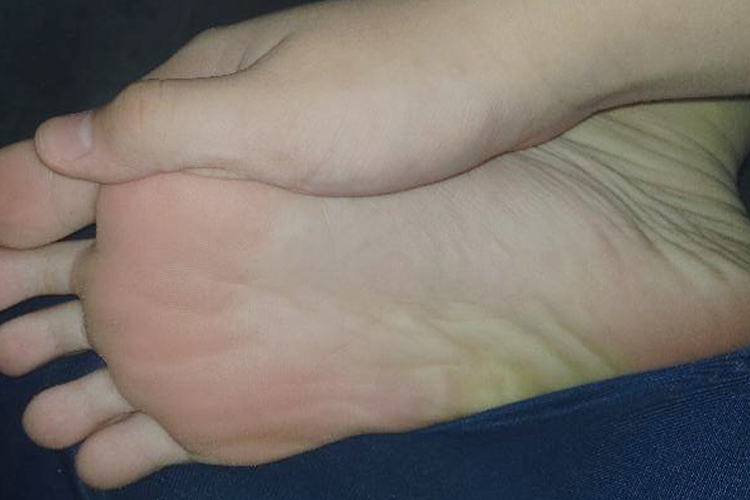 正常脚底横纹图 正常脚底横纹图