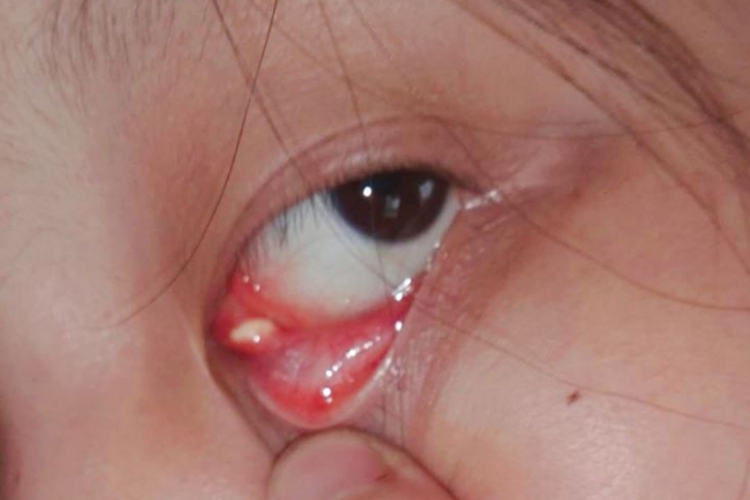 眼角结膜结石图