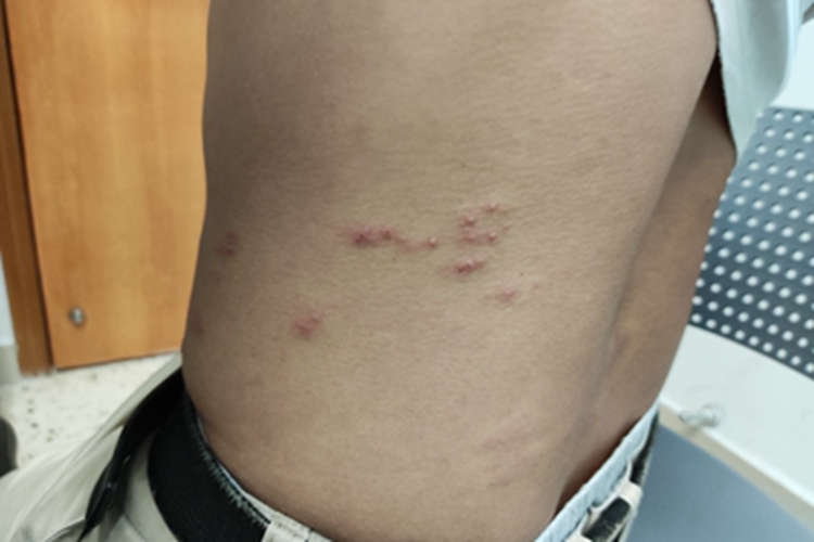 带状疱疹腰部丘疹图
