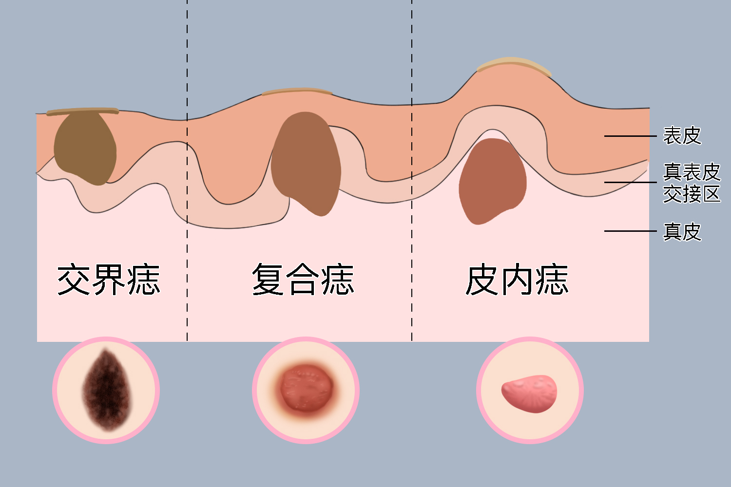 痣细胞痣示意图