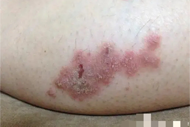 成人脂溢性皮炎大腿红斑图