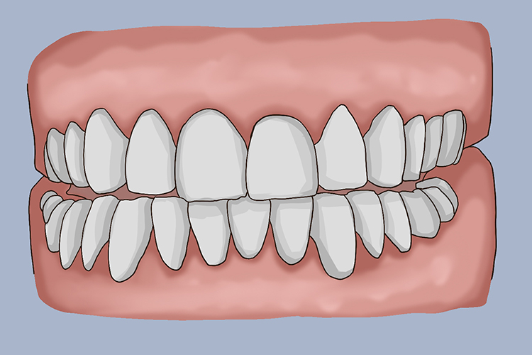 正常的前伸合图