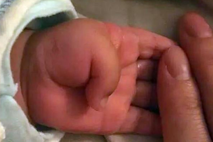 婴儿拇指内扣图