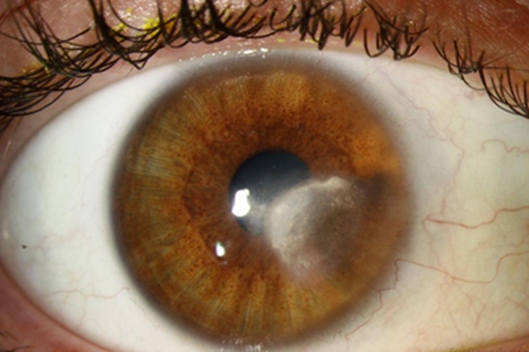 角膜变性眼球白斑图 角膜变性眼球白斑图