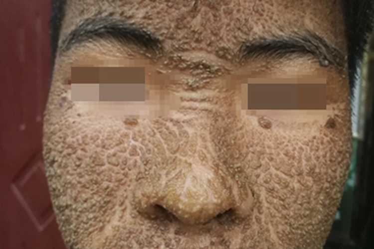 皮肤垢着病丘疹图