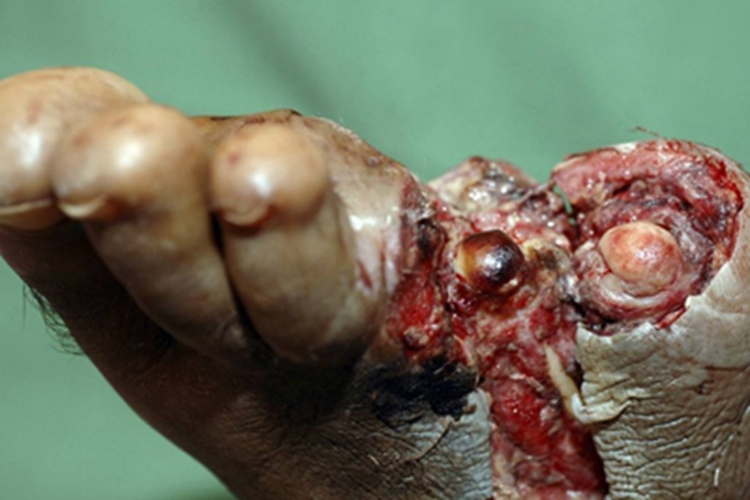 蜂窝织炎脚趾糜烂坏死图