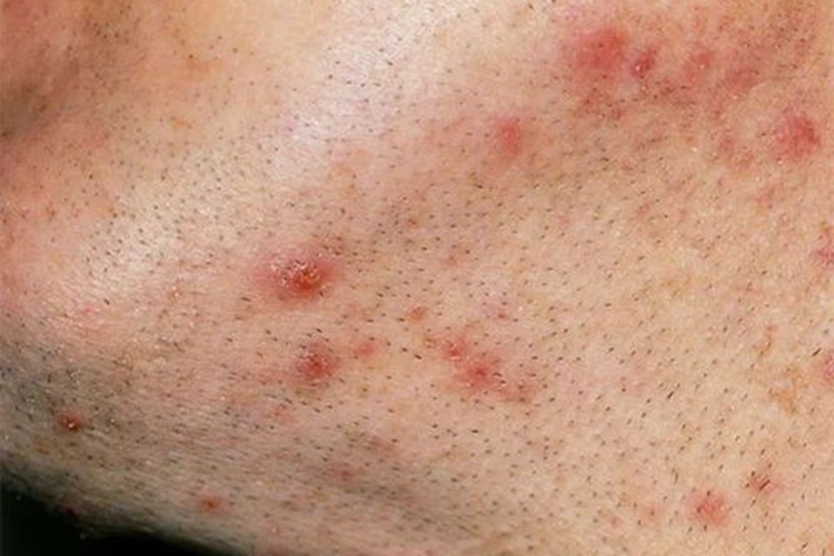 金黄色葡萄球菌性毛囊炎图 金黄色葡萄球菌性毛囊炎图