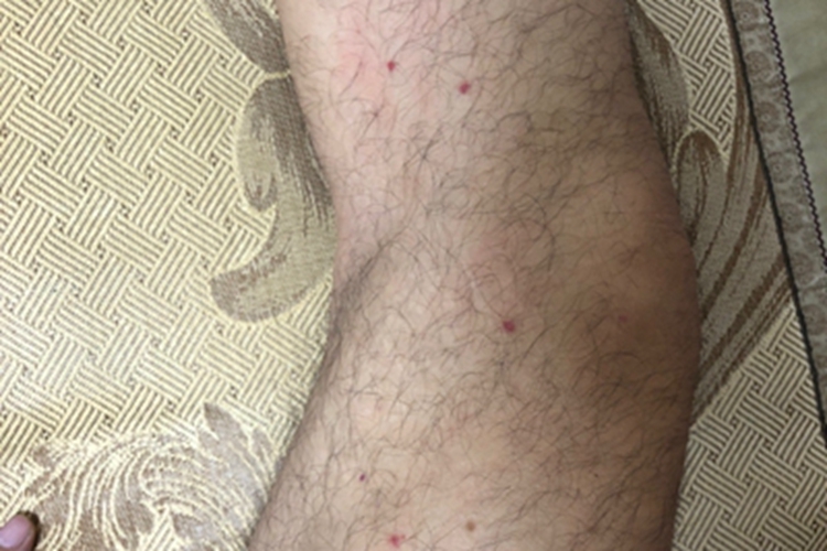 螨虫皮炎大腿上有红点图