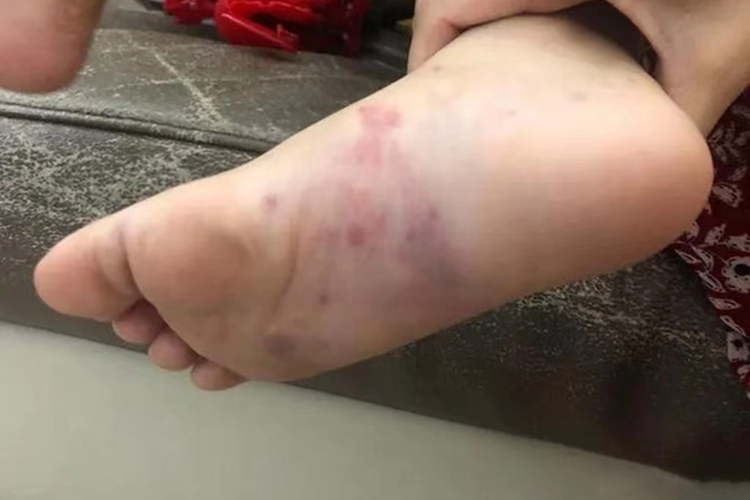 急性血小板减少性紫癜图