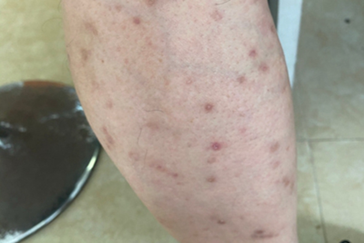 反应性穿通性胶原病症状图