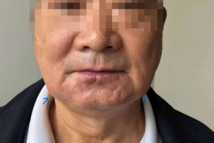 急性颌下腺炎图