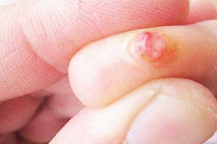 皮肤非典型分枝杆菌病手指硬包图 皮肤非典型分枝杆菌病手指硬包图