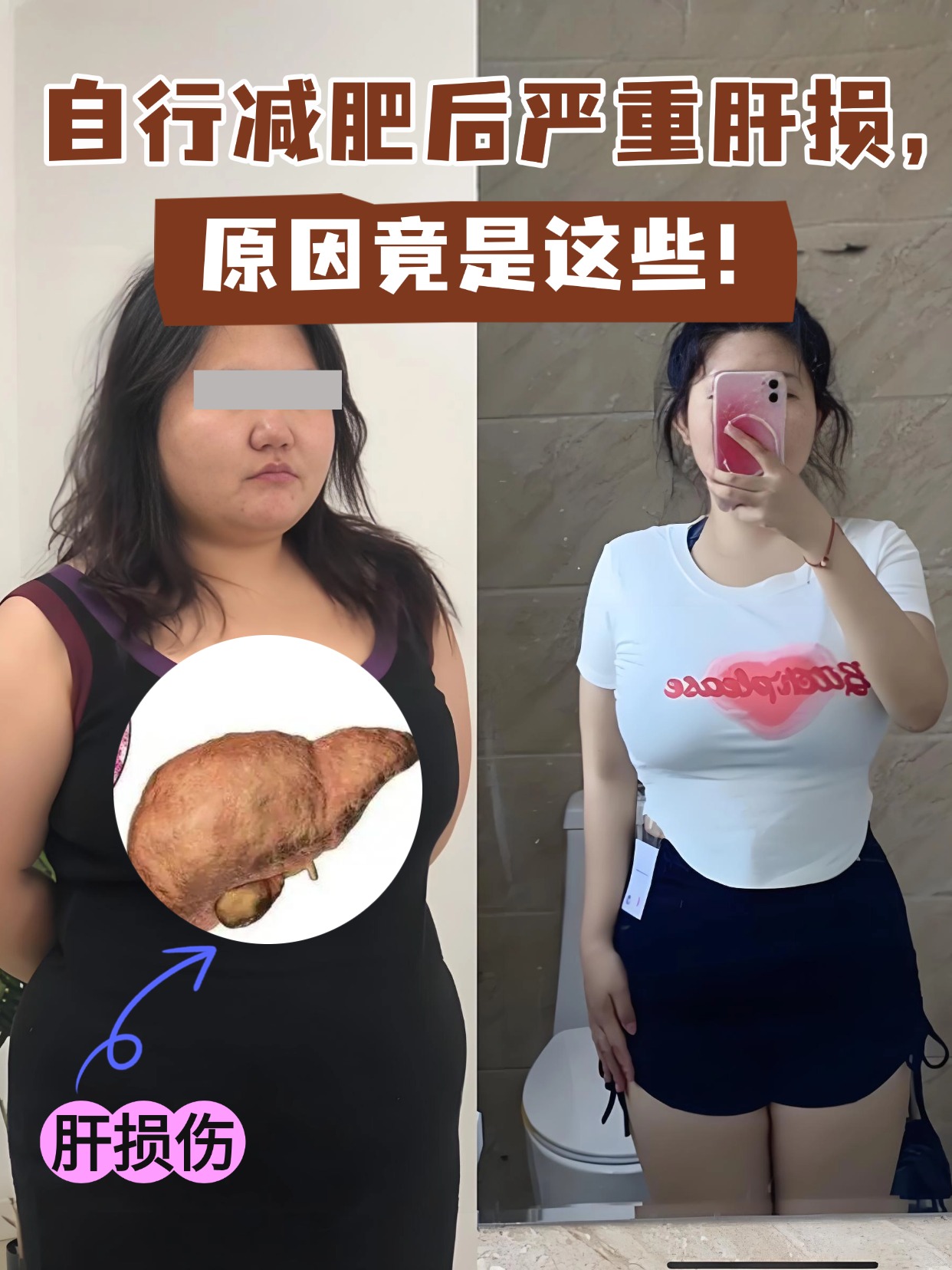 自行减肥后严重肝损,原因竟是这些!