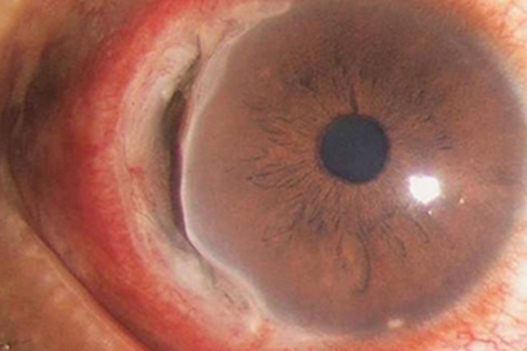 蚕蚀性角膜溃疡眼球边缘有斑图 蚕蚀性角膜溃疡眼球边缘有斑图