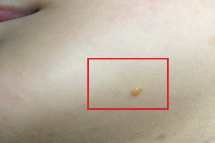 幼年黄色肉芽肿下巴症状图 幼年黄色肉芽肿下巴症状图