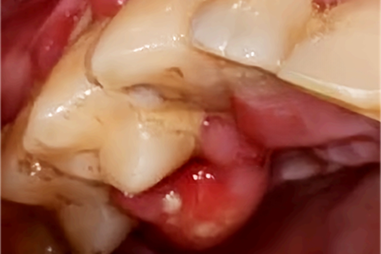 急性牙周脓肿脓包图