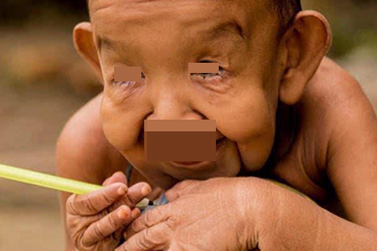 儿童早老症面部松弛图