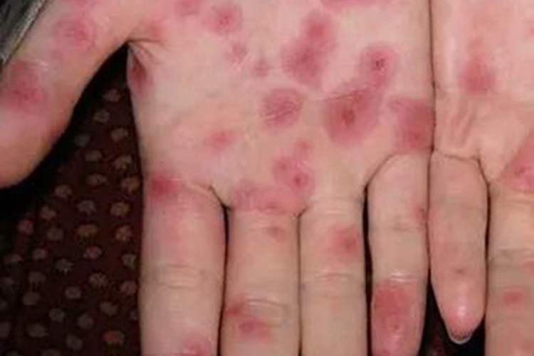 多形红斑手掌症状图