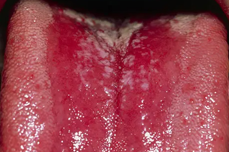 艾滋病早期舌口腔念珠菌病图