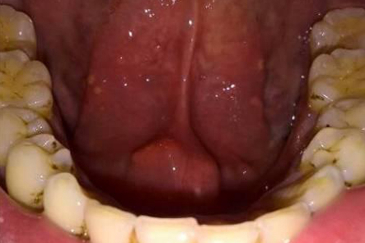 下颌下间隙肉阜肿大图