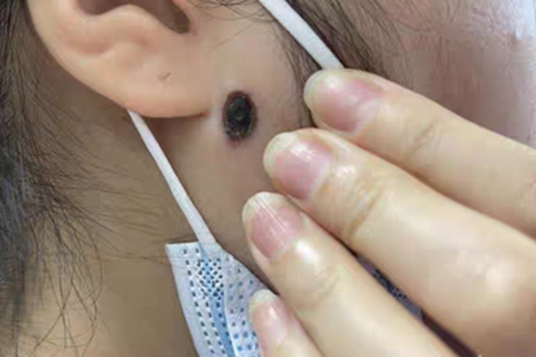 复合痣耳周黑斑图 复合痣耳周黑斑图