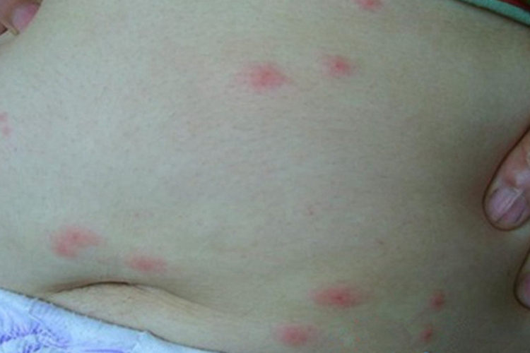 丘疹性荨麻疹图