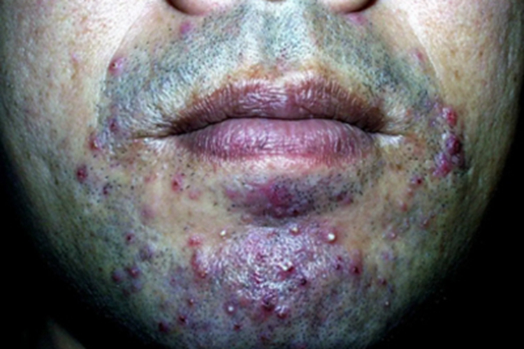 狼疮样须疮下巴结节症状图 狼疮样须疮下巴结节症状图