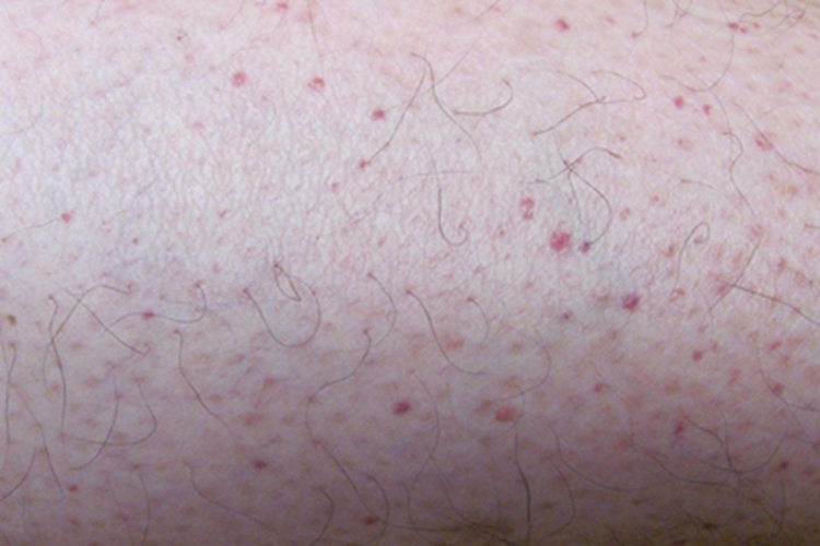 登革热小腿丘疹图 登革热小腿丘疹图