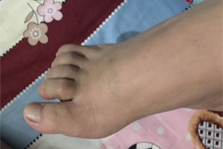 先天性高弓足脚趾畸形图