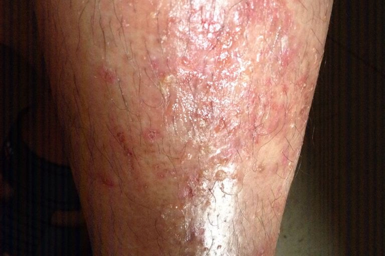 湿热毒引起的湿疮图