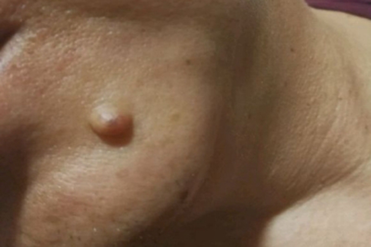 孤立性毛发上皮瘤大疙瘩图 孤立性毛发上皮瘤大疙瘩图