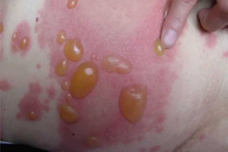 交界型大疱性表皮松解症红斑图