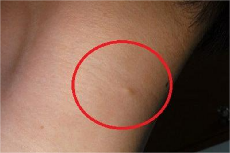 大腿根部淋巴结肿大皮损图 大腿根部淋巴结肿大皮损图