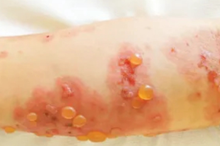 疱疹样湿疹胳膊水疱图