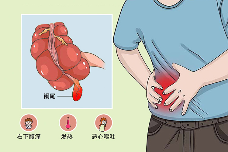 急性阑尾炎右下腹疼痛图