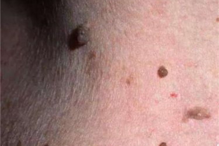 多发性皱纹状小丘疹症状图 多发性皱纹状小丘疹症状图