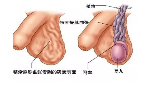 精索静脉曲张.png