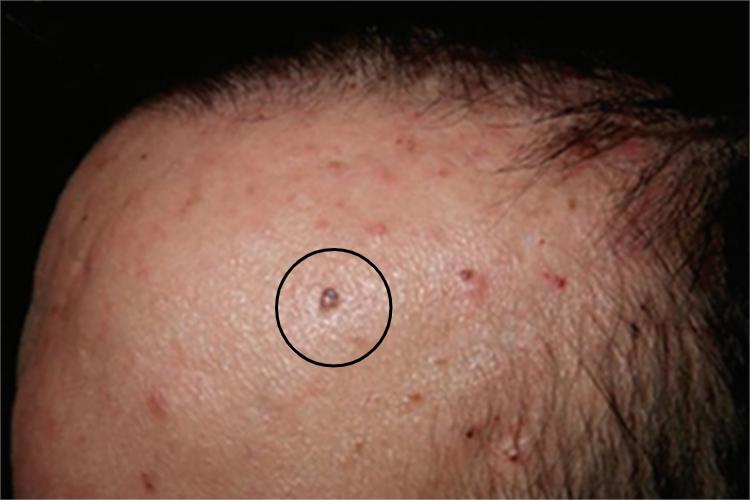 基底细胞痣综合征长痣图