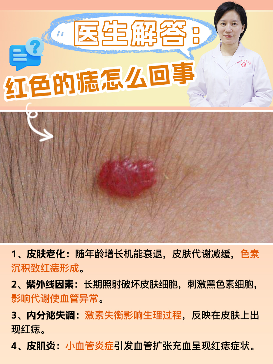 医生解答:红色的痣怎么回事