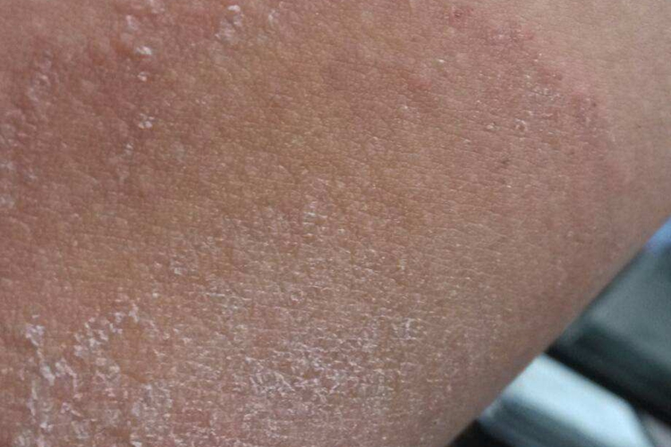 男孩大腿内侧亚急性湿疹图