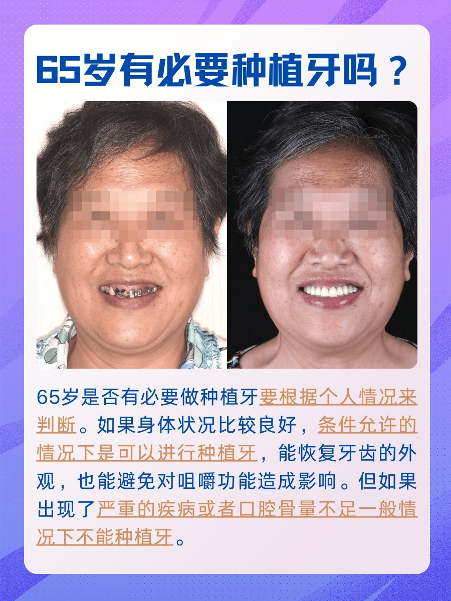 深度剖析：65岁种植牙有必要吗