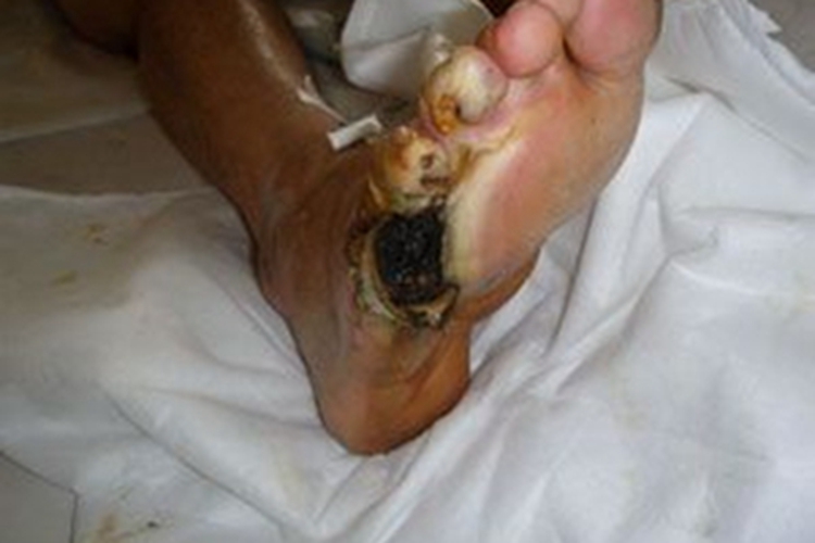 电烧伤脚底结痂图 电烧伤脚底结痂图