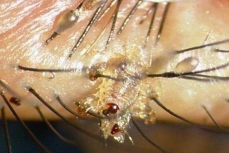 阴虱病睫毛症状图