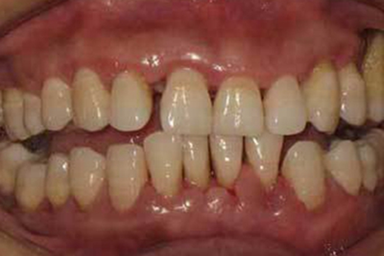 牙龈萎缩牙龈肿胀发紫图