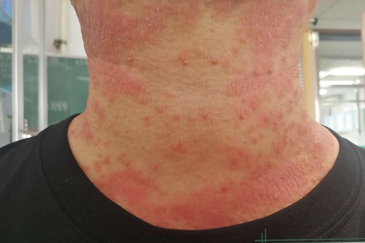 湿疹型多形性日光疹后颈症状图