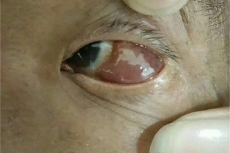 眼眶肿瘤眼部肿块图